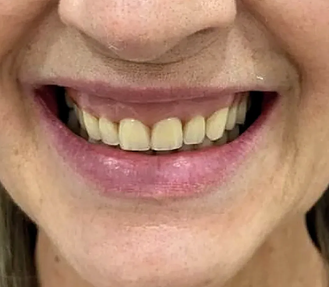 Sorriso antes do tratamento