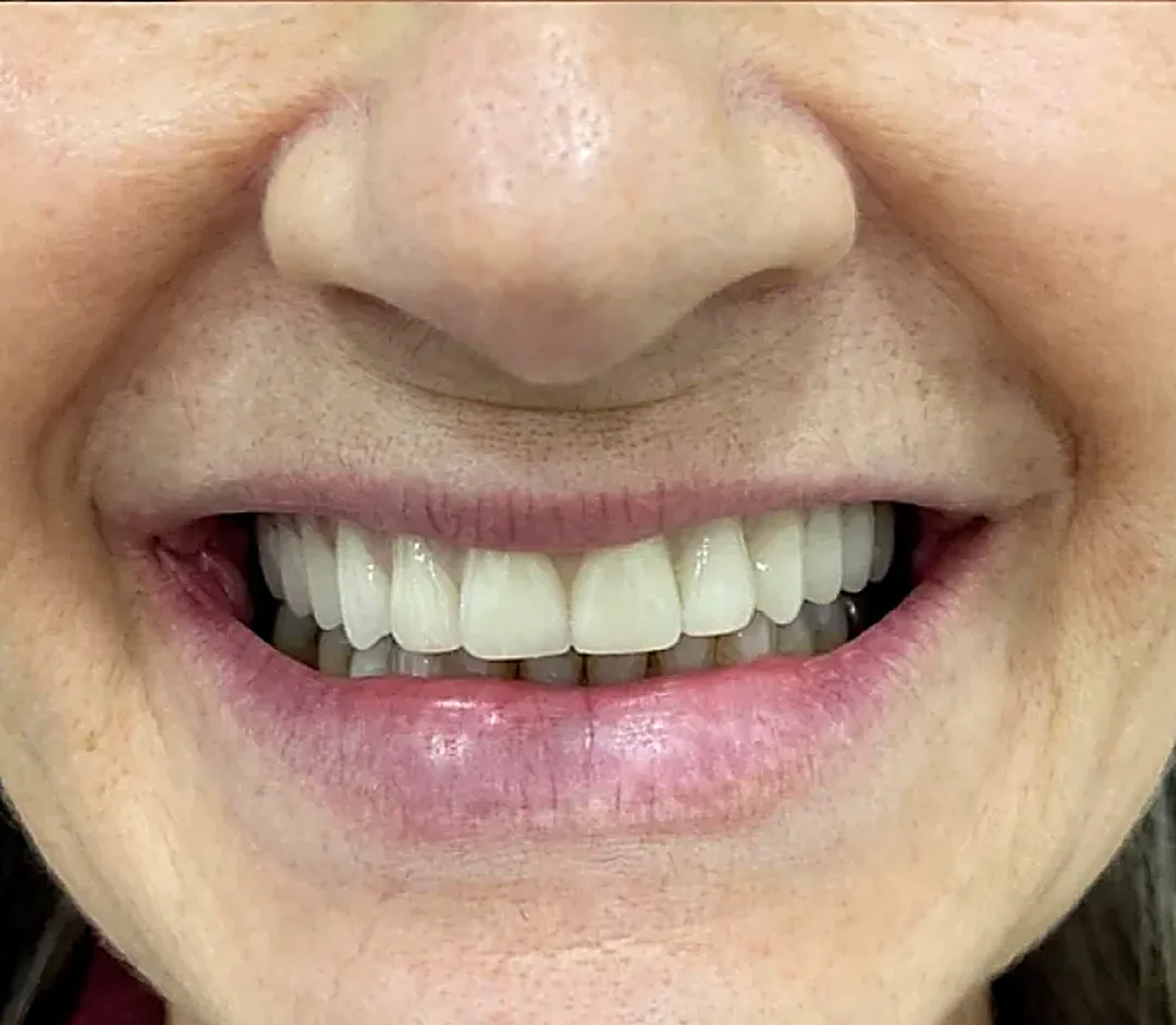 Sorriso depois do tratamento na Lumina Studio Dental